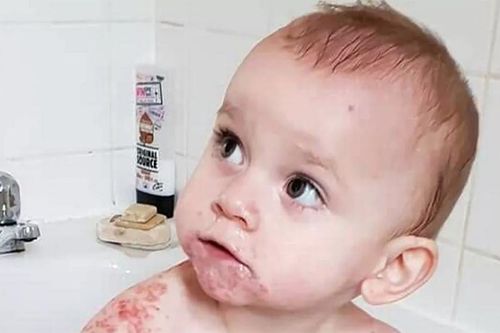 Bé gái 1 tuổi suýt chết sau nụ hôn của người họ hàng