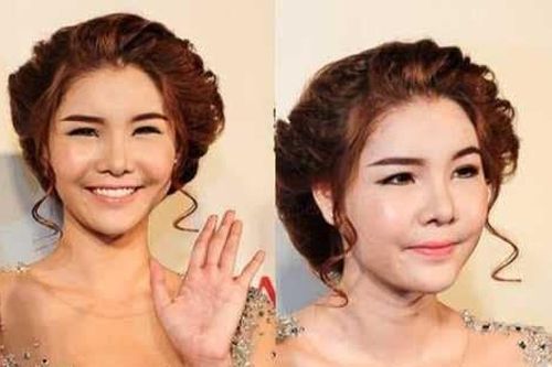 Người mẫu Kỳ Hân - vợ Mạc Hồng Quân - khủng hoảng vì khuôn mặt biến dạng do phẫu thuật thẩm mỹ