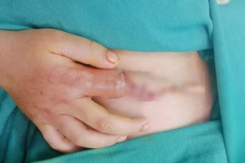 Nối ngón tay vào bụng giúp 2 bé bị điện giật không phải cắt cụt chi