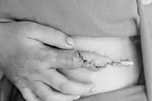 Cấy ngón tay vào bụng cứu bé trai thoát cảnh cắt cụt chi