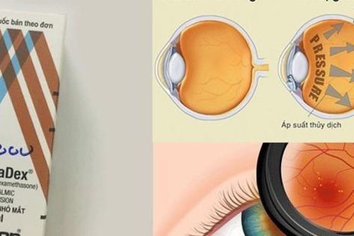 Mù một bên mắt vì dùng thuốc nhỏ mắt kéo dài