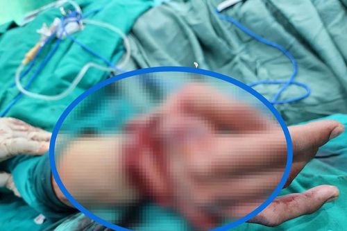 Nối bàn tay đứt lìa cho bệnh nhân bị tai nạn lao động