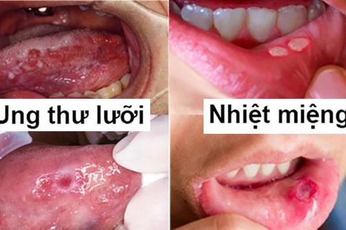 Bé 3 tuổi thoát 'án tử' sau 2 năm điều trị ung thư lưỡi, đây là những dấu hiệu cảnh báo bệnh, không được bỏ qua!