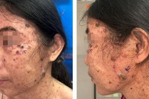 Chi chít mụn hạt cơm, người phụ nữ tá hỏa khi mắc ung thư da hiếm gặp