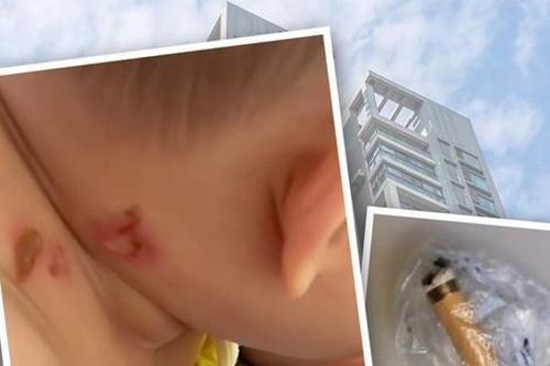 Mẩu thuốc lá rơi từ tầng cao khiến bé 4 tháng tuổi phải nhập viện