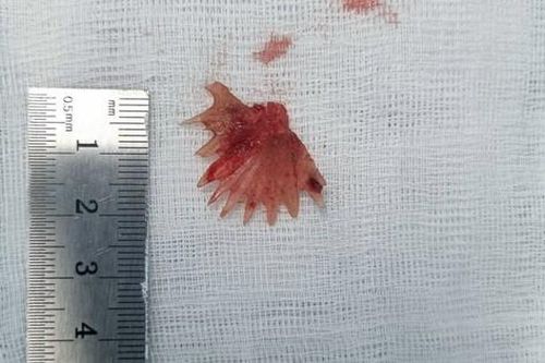 Bị hóc xương cá hình răng cưa hơn 2cm ở thực quản
