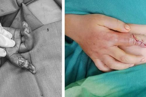 Nhiều trẻ bỏng điện bị nhiễm trùng nặng do người thân tự ý điều trị ở nhà