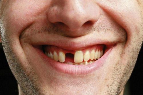 Nhật Bản phát triển thuốc giúp kích thích răng mọc trở lại