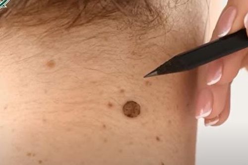 Phát hiện ung thư da sau nhiều năm không thăm khám
