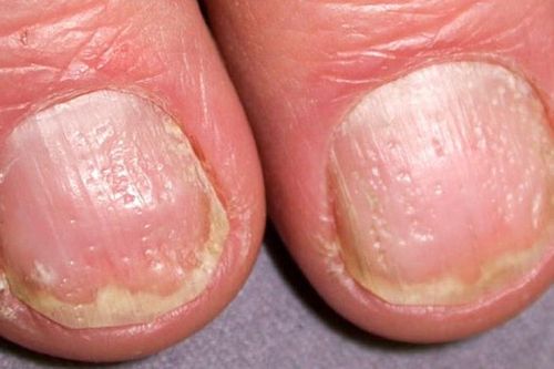 Móng tay có chấm lỗ là bệnh gì? Có điều trị được không?