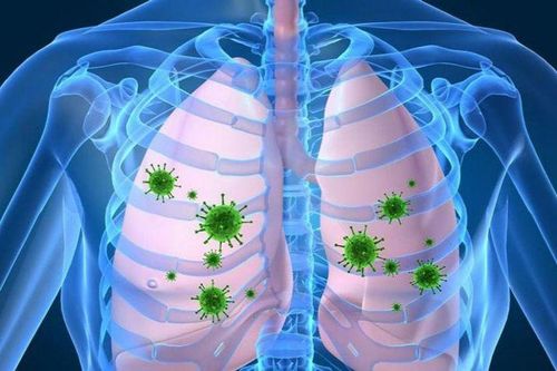 Thay đổi thời tiết, tuyệt đối không chủ quan với bệnh viêm phổi