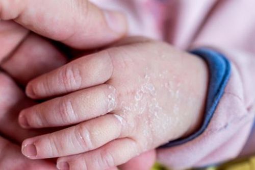 Cảnh báo tình trạng trẻ thiếu chất có thể ảnh hưởng đến khả năng học tập