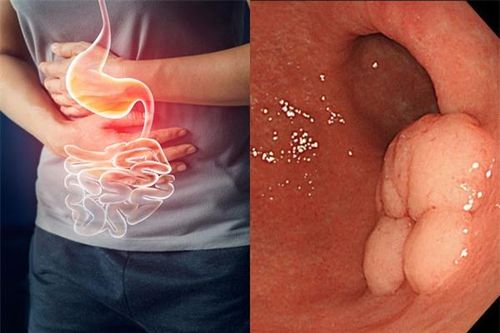 Các triệu chứng liên quan tới ung thư dạ dày, cần đi gặp bác sĩ ngay