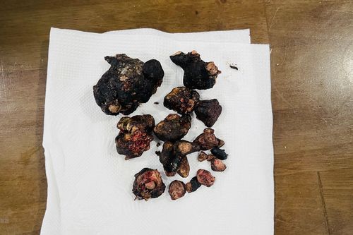 Đồng Nai: Lấy thành công khối san hô 'khổng lồ' trong thận bệnh nhân