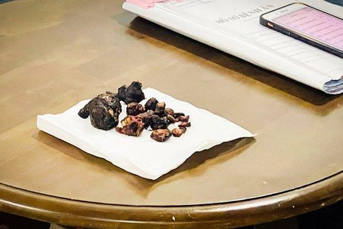 Đồng Nai: Phát hiện khối sỏi san hô lớn trong người bệnh nhân