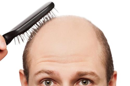 Phát hiện mới về gene gây hói