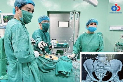 Thủng tử cung, đại tràng…vì vòng tránh thai