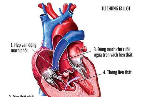 Bệnh tim bẩm sinh