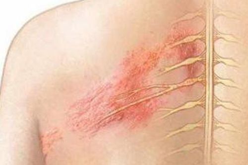 Zona thần kinh chữa thế nào để nhanh khỏi?