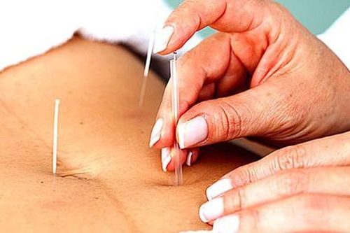 Châm cứu có giảm cân được không?