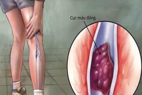 Phòng huyết khối tĩnh mạch sâu nhờ 7 bước đơn giản ai cũng có thể thực hiện