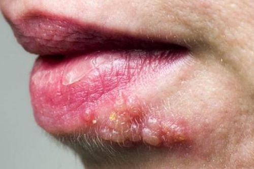 Bệnh Zona có xu hướng tăng sau đại dịch COVID-19
