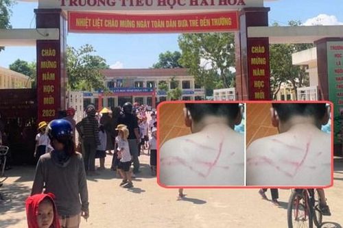 Vụ học sinh bị đánh bầm tím ở lưng: Đình chỉ công tác giáo viên chủ nhiệm 15 ngày