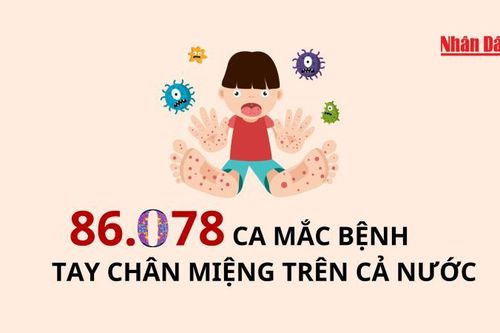 86.078 ca mắc bệnh tay chân miệng trên cả nước