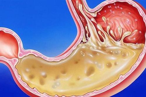 Người bị trào ngược dạ dày - thực quản cần bỏ ngay những thói quen khiến bệnh nặng hơn