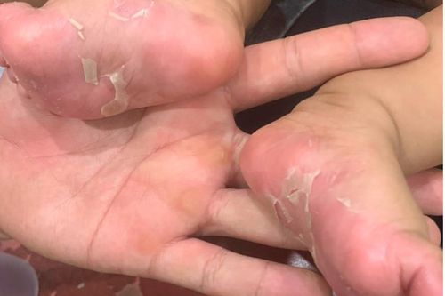 Bố, mẹ và bé trai sơ sinh 3 tháng tuổi cùng mắc bệnh giang mai