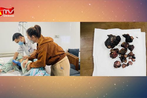 Lấy thành công khối san hô khổng lồ trong thận bệnh nhân, kích thước đến 8cm