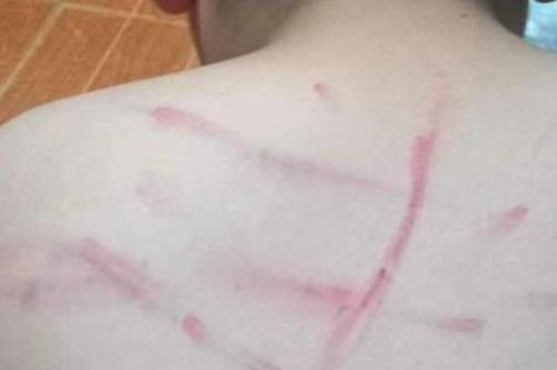 Thanh Hóa: Chấm dứt hợp đồng với cô giáo đánh học sinh lớp 4 bầm tím lưng