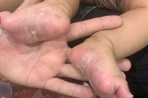Bé trai 3 tháng tuổi mắc bệnh giang mai