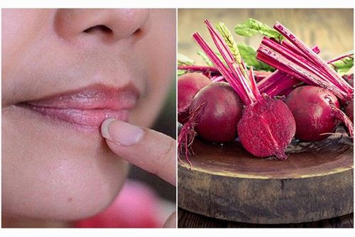 Có nên dùng củ dền đỏ trị thâm môi?