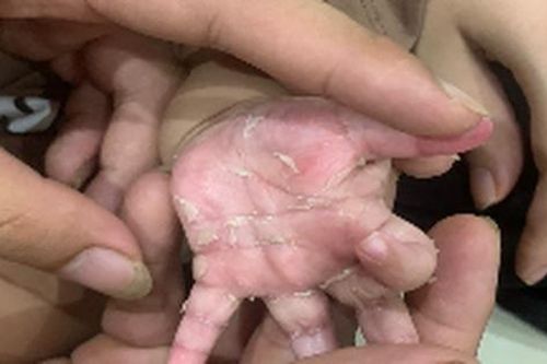 Bé trai 3 tháng tuổi lây giang mai từ mẹ