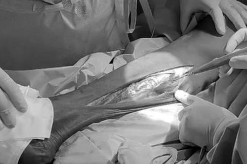 Hút thuốc nhiều năm, cụ ông suýt bị cắt cụt chân