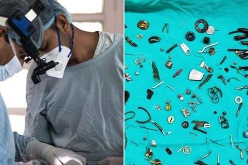 Bệnh nhân kêu đau bụng, bác sĩ khám phát hiện có 60 món đồ bị nuốt vào trong bụng