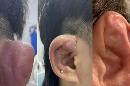 Nam thanh niên nhập viện sau khi xỏ khuyên tai