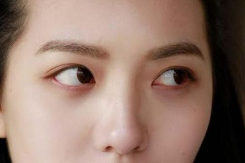 Nữ sinh viên bị đột quỵ mắt, da nhăn nheo vì 1 thói quen nhiều người trẻ hay làm