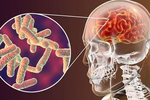 'Sống thực vật' nếu điều trị muộn lao màng não