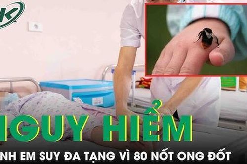 2 trẻ suy đa tạng do ong đốt