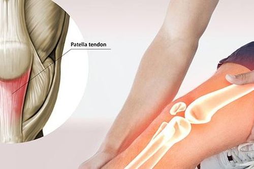 Viêm gân bánh chè tập thế nào để nhanh hồi phục?