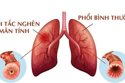 Bệnh phổi tắc nghẽn mạn tính: Nguyên nhân gây tử vong xếp hàng thứ 3