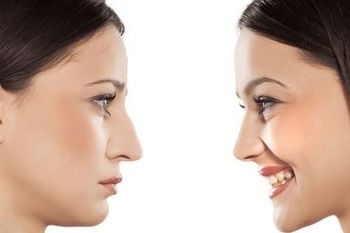 Nâng mũi có thể khiến mũi mất đi hình dạng khi về già
