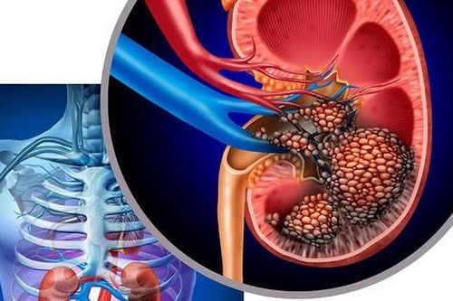 U thận có nguy hiểm không?