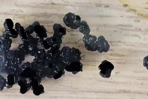 Bé gái 9 tuổi đã phát hiện sỏi túi mật, bệnh có nguy hiểm không?