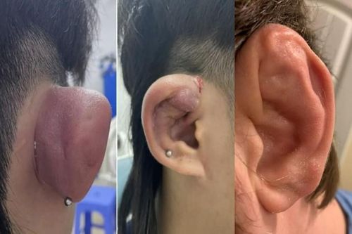 Nhập viện vì… bấm lỗ tai