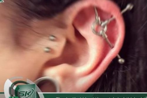 Thanh niên bị hoại tử sụn tai vì sở thích xỏ nhiều lỗ