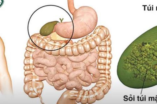 Phát hiện nhiều sỏi trong túi mật của bé gái 9 tuổi