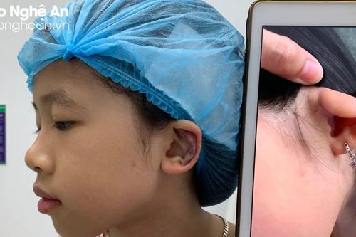 Bé gái 8 tuổi được tạo hình tai thành công tại Bệnh viện Chấn thương - Chỉnh hình Nghệ An